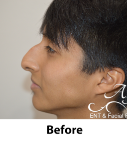 Before and After Pictures McAllen, TX - Ayala ENT and Facial Plastic Surgery