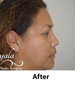 Before and After Pictures McAllen, TX - Ayala ENT and Facial Plastic Surgery