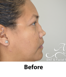 Before and After Pictures McAllen, TX - Ayala ENT and Facial Plastic Surgery
