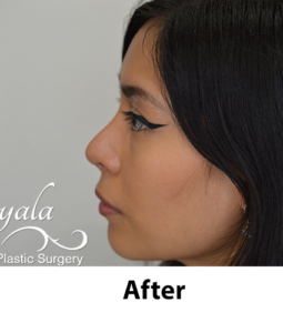 Before and After Pictures McAllen, TX - Ayala ENT and Facial Plastic Surgery