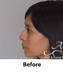 Rhinoplasty Before and After Pictures McAllen, TX