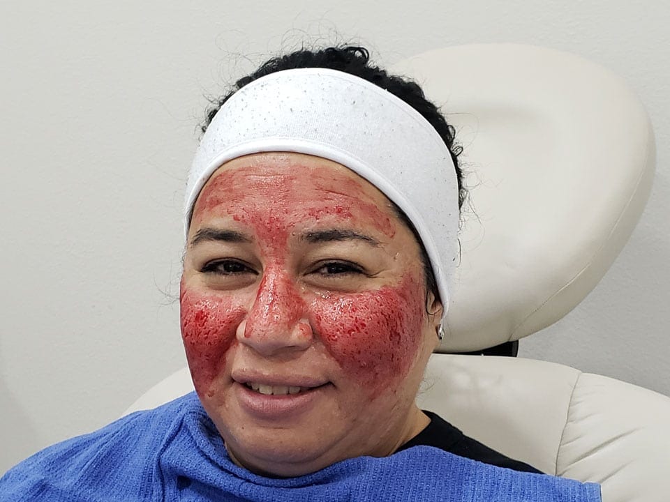 Acne Treatments in McAllen, TX