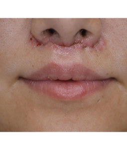 Before and After Pictures McAllen, TX - Ayala ENT and Facial Plastic Surgery