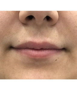 Before and After Pictures McAllen, TX - Ayala ENT and Facial Plastic Surgery