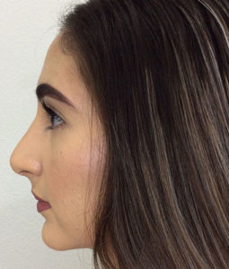 Before and After Pictures McAllen, TX - Ayala ENT and Facial Plastic Surgery