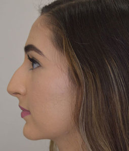 Before and After Pictures McAllen, TX - Ayala ENT and Facial Plastic Surgery