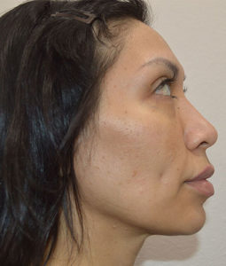 Before and After Pictures McAllen, TX - Ayala ENT and Facial Plastic Surgery