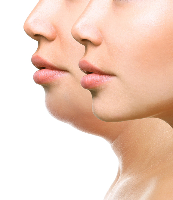 Chin Augmentation in McAllen, TX