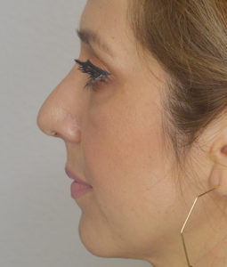 Before and After Pictures McAllen, TX - Ayala ENT and Facial Plastic Surgery