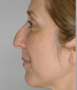 Before and After Pictures McAllen, TX - Ayala ENT and Facial Plastic Surgery