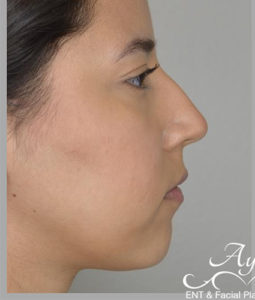 Before and After Pictures McAllen, TX - Ayala ENT and Facial Plastic Surgery