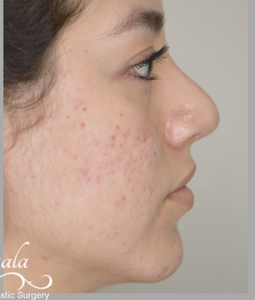 Before and After Pictures McAllen, TX - Ayala ENT and Facial Plastic Surgery