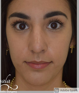 Before and After Pictures McAllen, TX - Ayala ENT and Facial Plastic Surgery