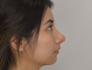 Before and After Pictures McAllen, TX - Ayala ENT and Facial Plastic Surgery