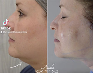 Ayala ENT & Facial Plastic Surgery