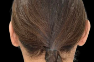 Before and After Pictures McAllen, TX - Ayala ENT and Facial Plastic Surgery