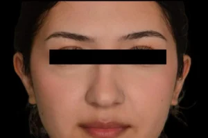 Before and After Pictures McAllen, TX - Ayala ENT and Facial Plastic Surgery