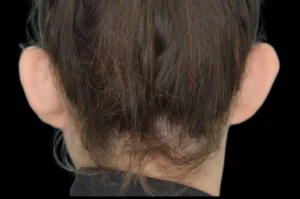 Before and After Pictures McAllen, TX - Ayala ENT and Facial Plastic Surgery