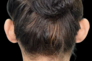 Before and After Pictures McAllen, TX - Ayala ENT and Facial Plastic Surgery