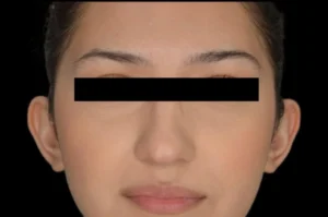 Before and After Pictures McAllen, TX - Ayala ENT and Facial Plastic Surgery