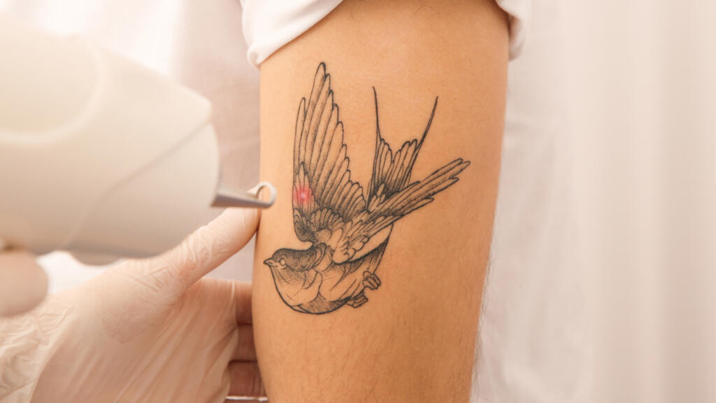 Laser Tattoo Removal