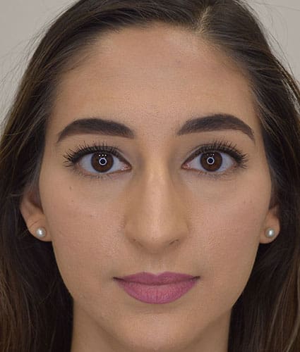 Rhinoplasty Case 26 – Before