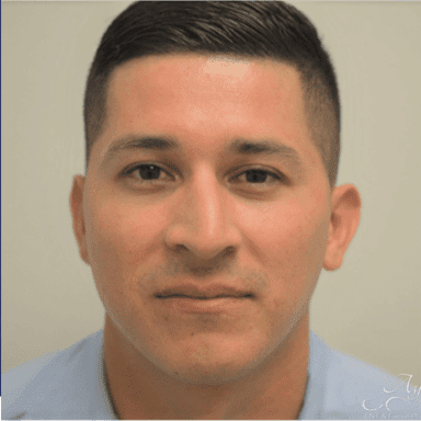Rhinoplasty Case 10 – Before