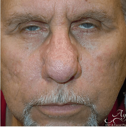 Rhinoplasty Case 19 – Before