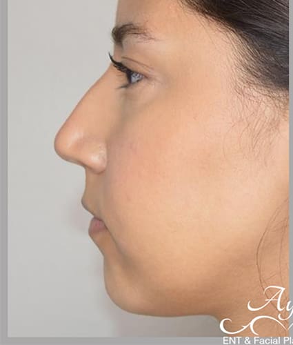 Rhinoplasty Case 36 – Before