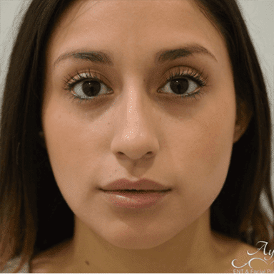 Rhinoplasty Case 2 – Before