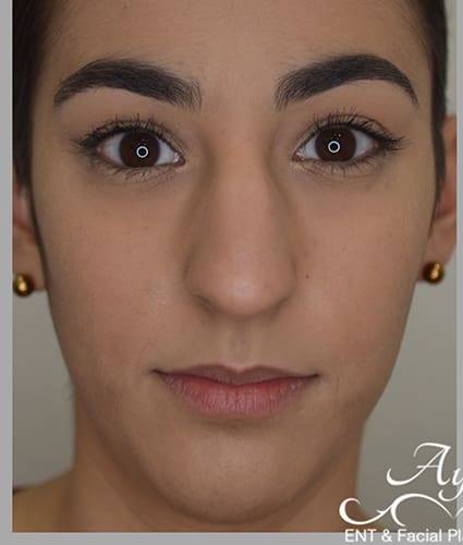Rhinoplasty Case 38 – Before