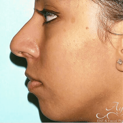 Rhinoplasty Case 20 – Before