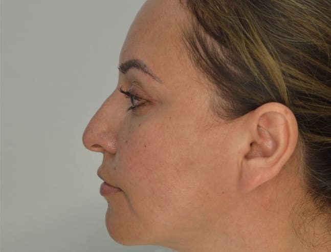 Rhinoplasty Case 39 – Before