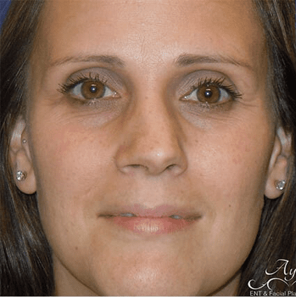 Rhinoplasty Case 21 – Before