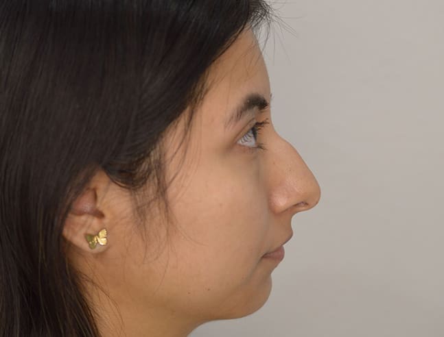 Rhinoplasty Case 40 – Before