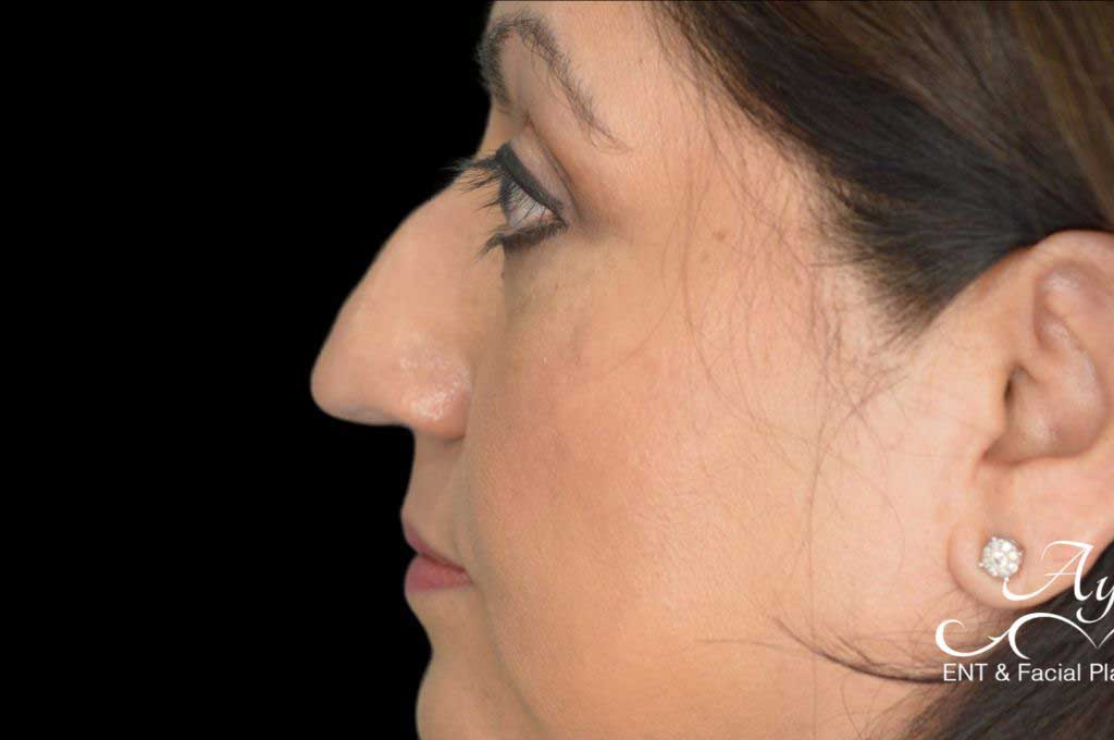 Rhinoplasty Case 42 – Before