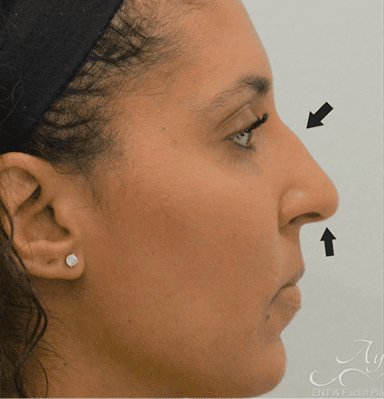 Rhinoplasty Case 3 – Before