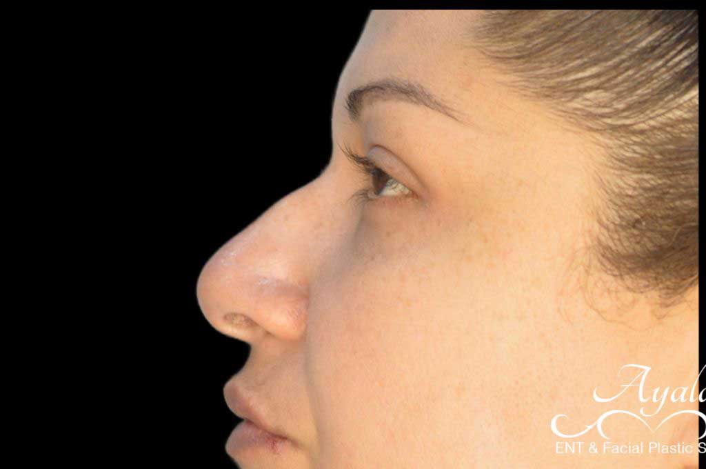 Rhinoplasty Case 44 – Before