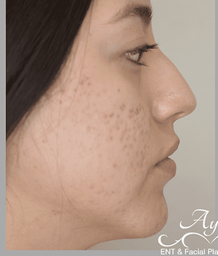 Rhinoplasty Case 37 – Before