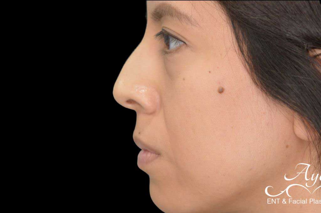 Rhinoplasty Case 45 – Before