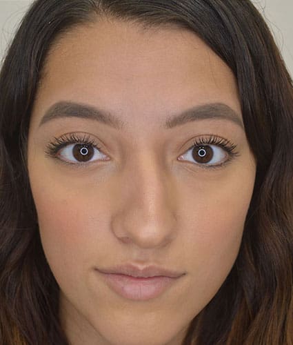 Rhinoplasty Case 27 – Before