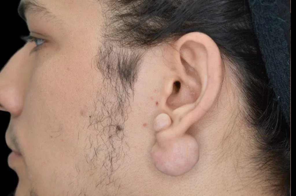 Ear Surgery Case 12 – Before