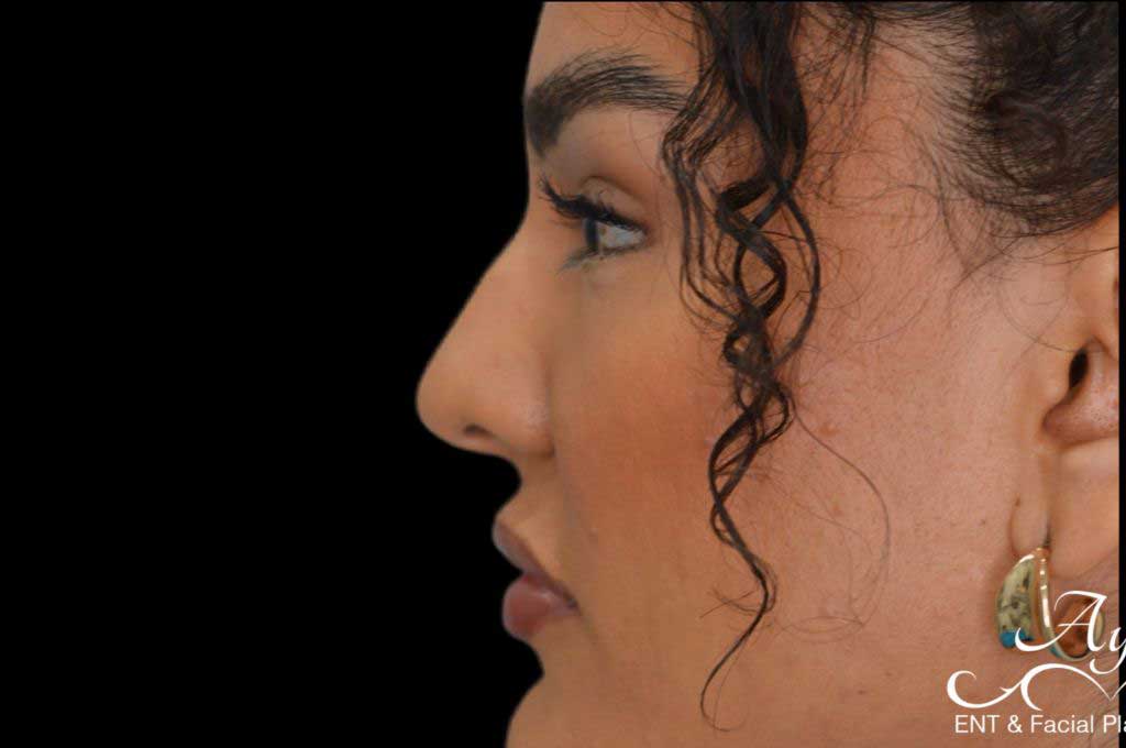 Rhinoplasty Case 46 – Before