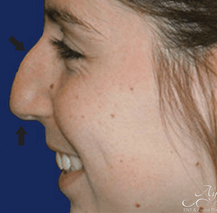 Rhinoplasty Case 5 – Before