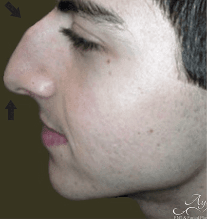 Rhinoplasty Case 6 – Before