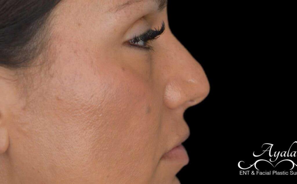 Rhinoplasty Case 48 – Before