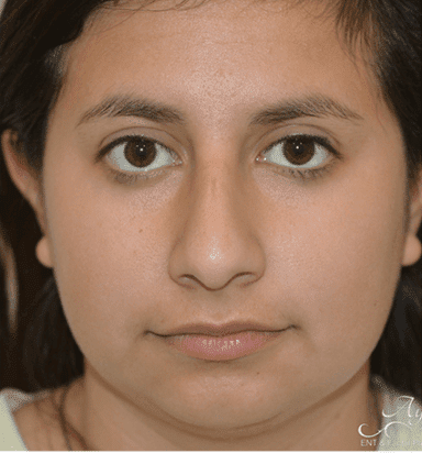 Rhinoplasty Case 7 – Before
