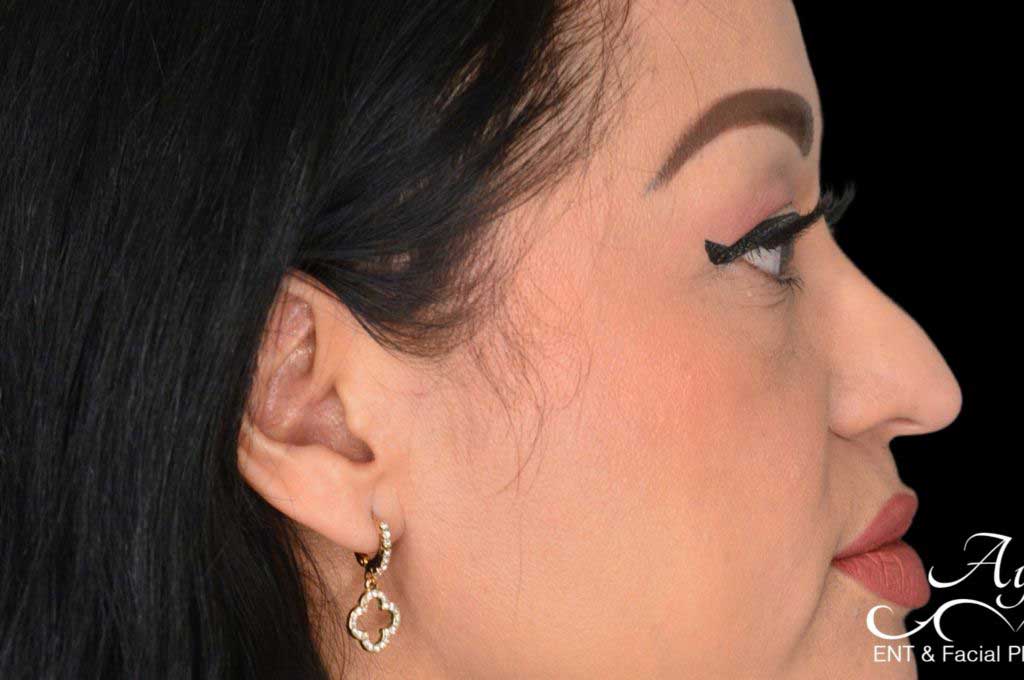Rhinoplasty Case 49 – Before