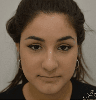 Rhinoplasty Case 8 – Before