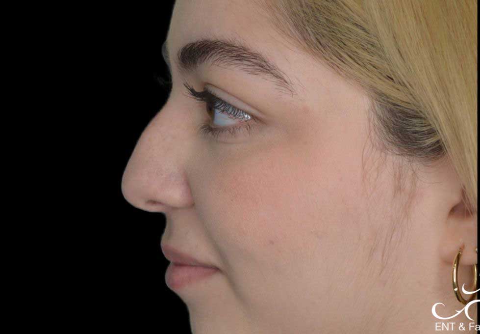 Rhinoplasty Case 50 – Before